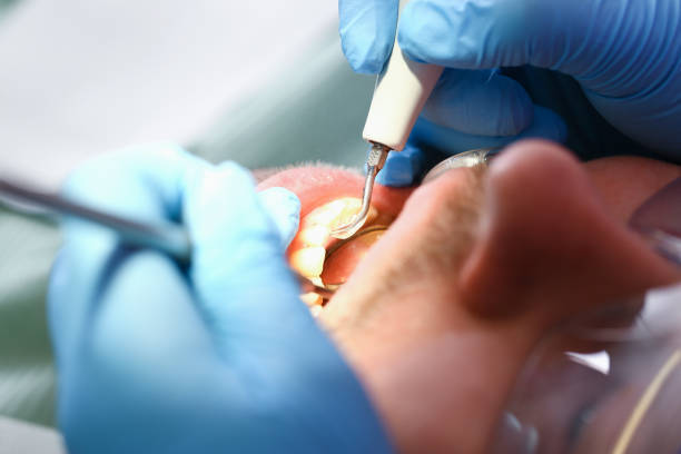 Best Dental Abscess Treatment in Battle Ground, WA